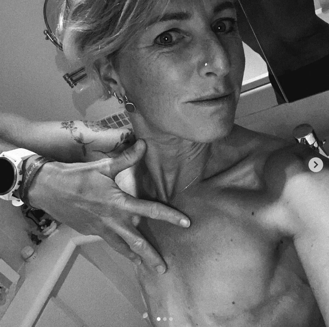 Scars and body image after cancer treatment