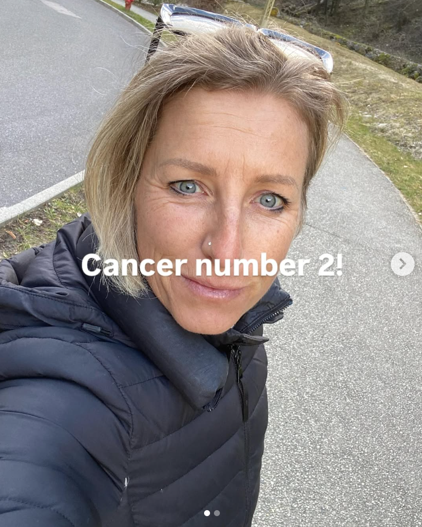 Cancer number 2: Skin cancer, probably caused by radiotherapy.