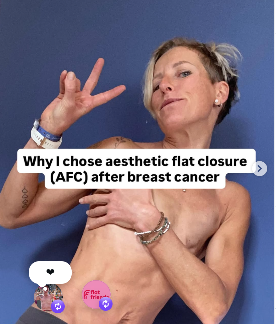 Why I chose Aesthetic Flat Closure after breast cancer. And what living as a ‘flattie’ is really like.