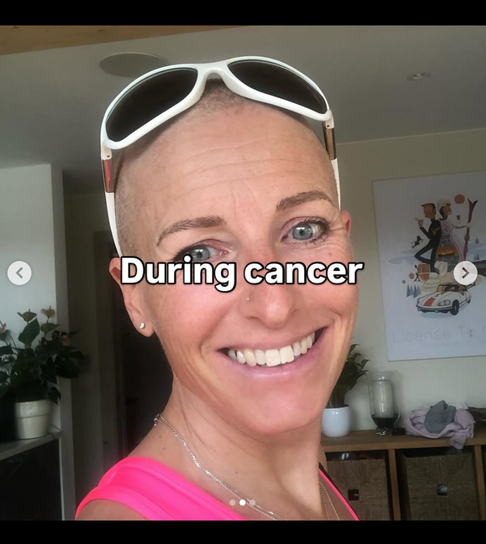 During cancer treatment, I had no hair and felt like a warrior