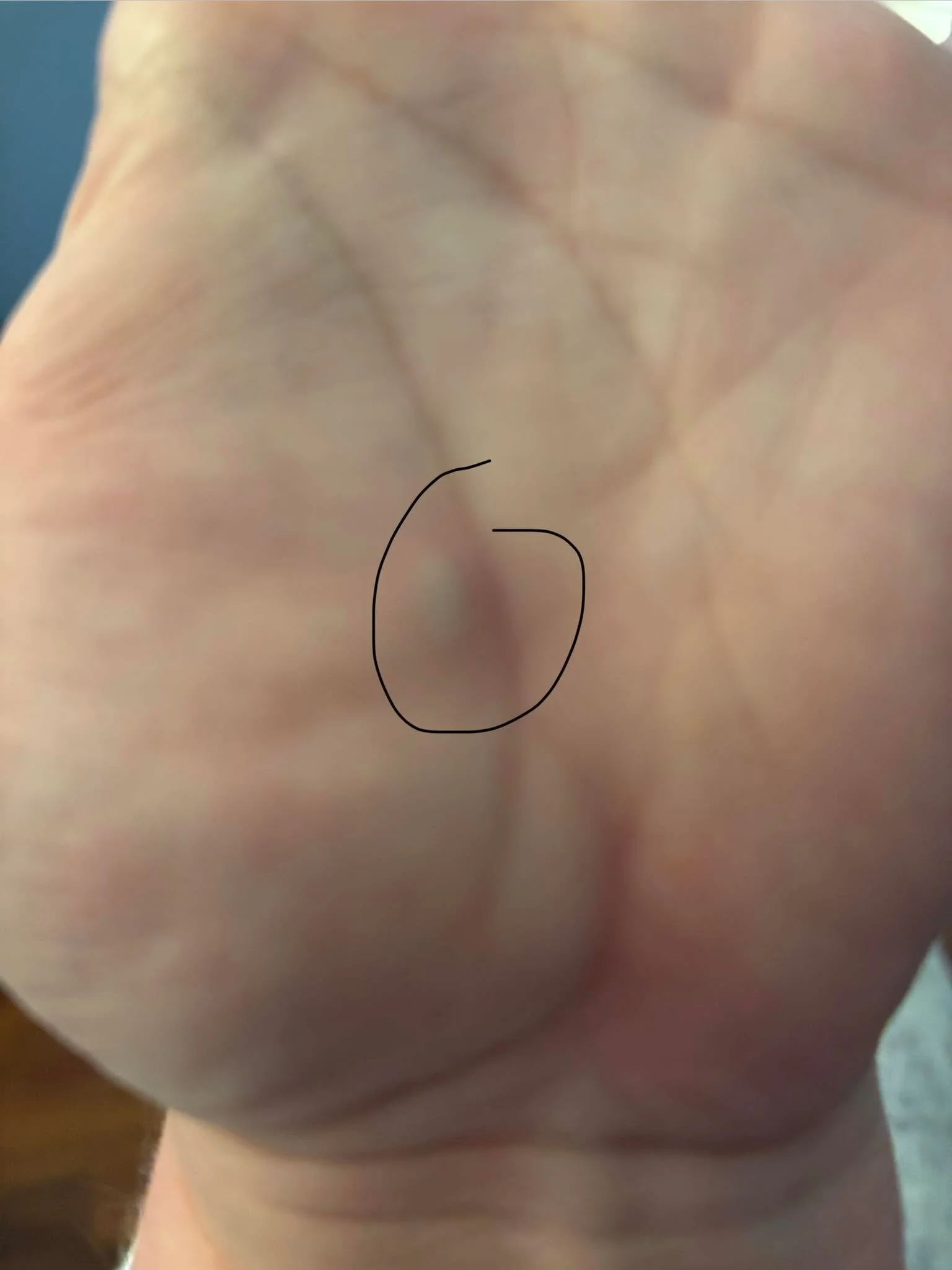 Any of my author peeps ever get knots in your palms like this?