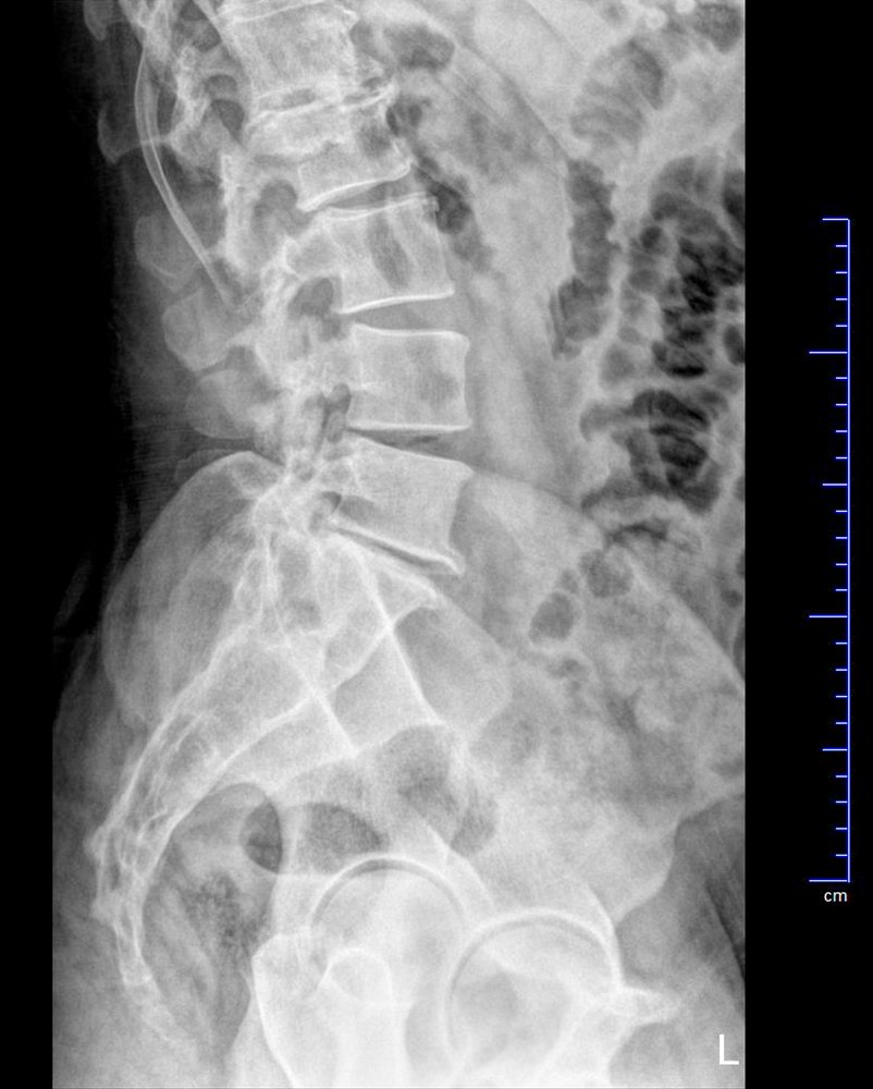 A Remarkable Case Study with a Burst Spinal Cord Fracture and Scalp Acupuncture