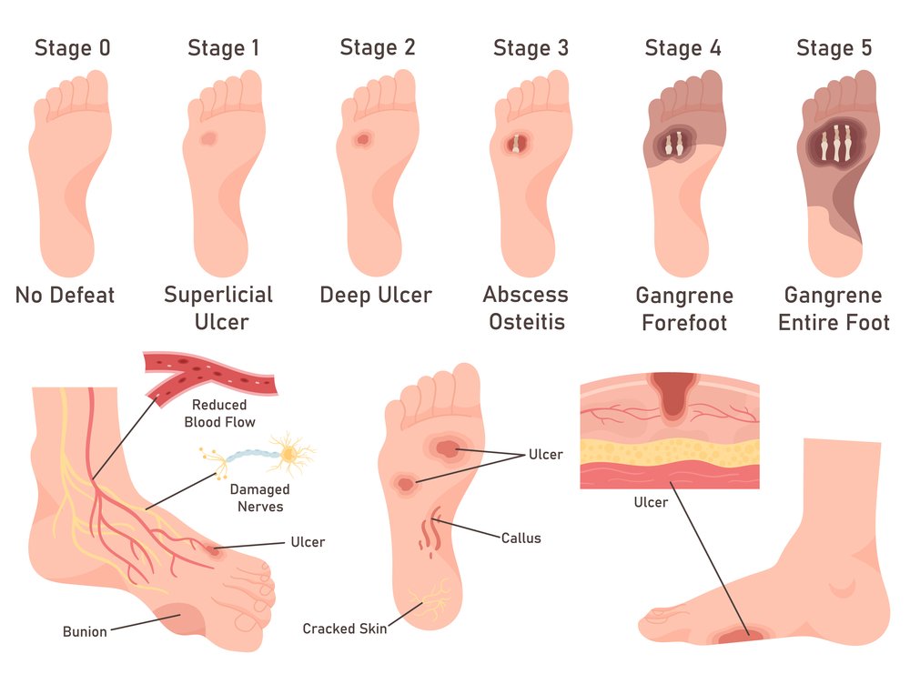 A research review of treating Peripheral Diabetic Neuropathy with acupuncture.