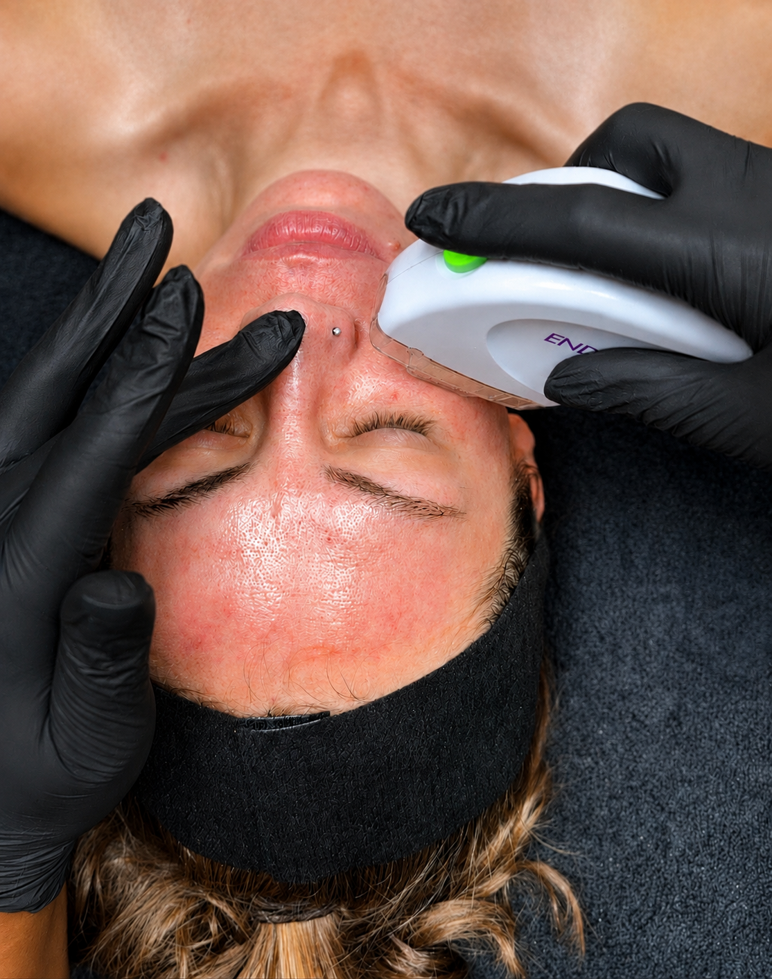 Client receiving RF microneedling to improve acne scarring, pores and uneven skin texture.
