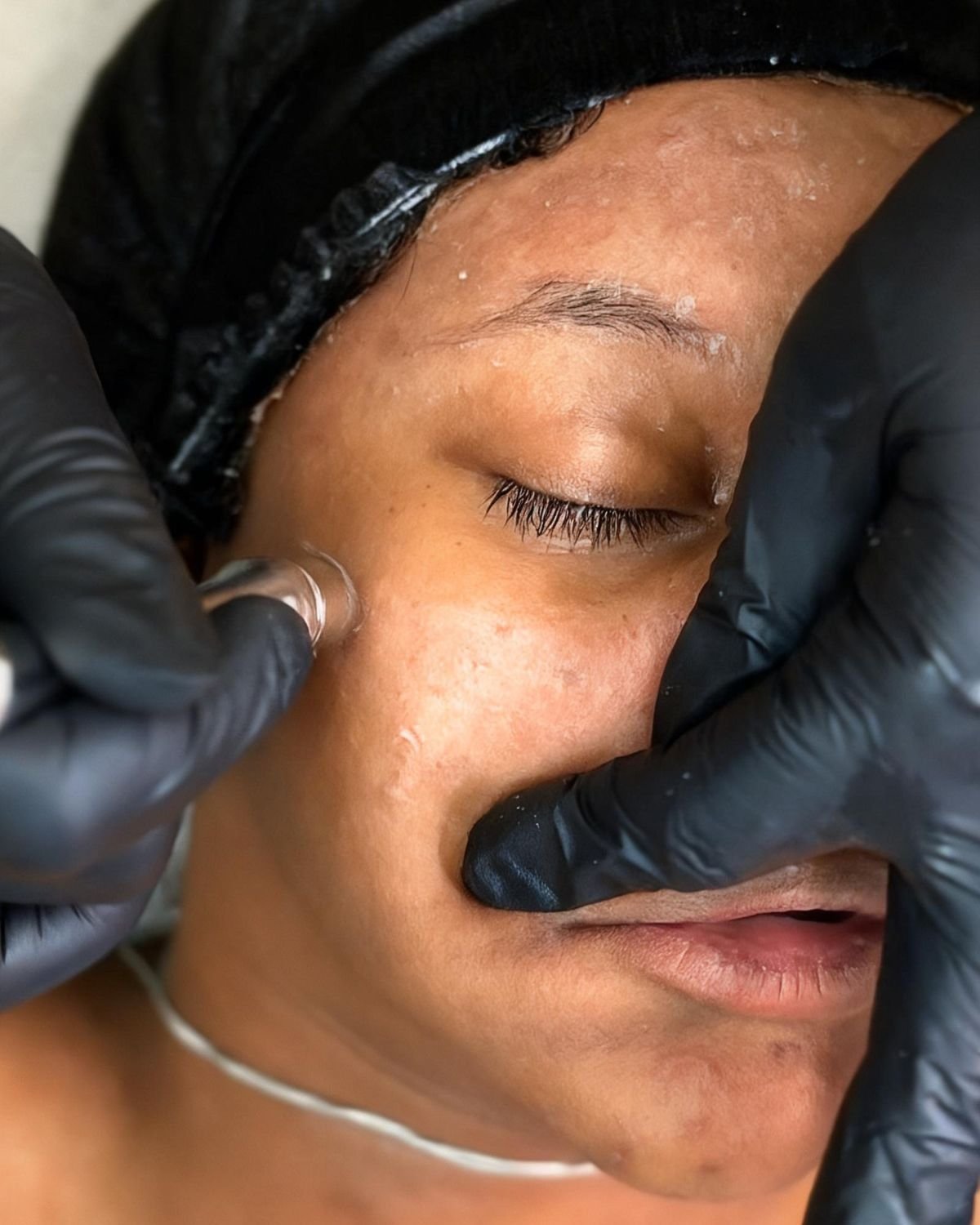Client receiving a corrective facial treatment for dark spots, acne and uneven skin texture.