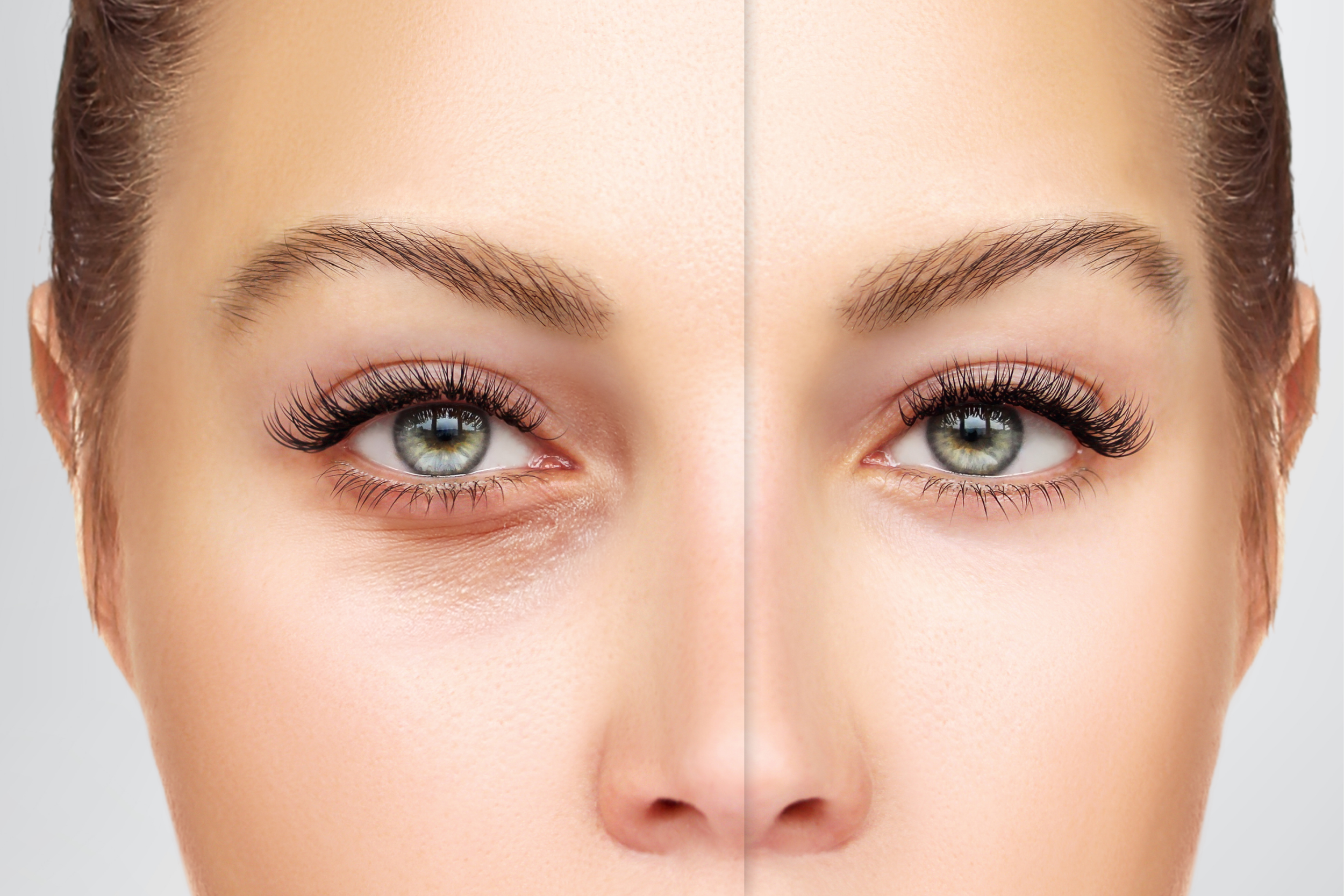 before and after eyelid lift surgery dubai