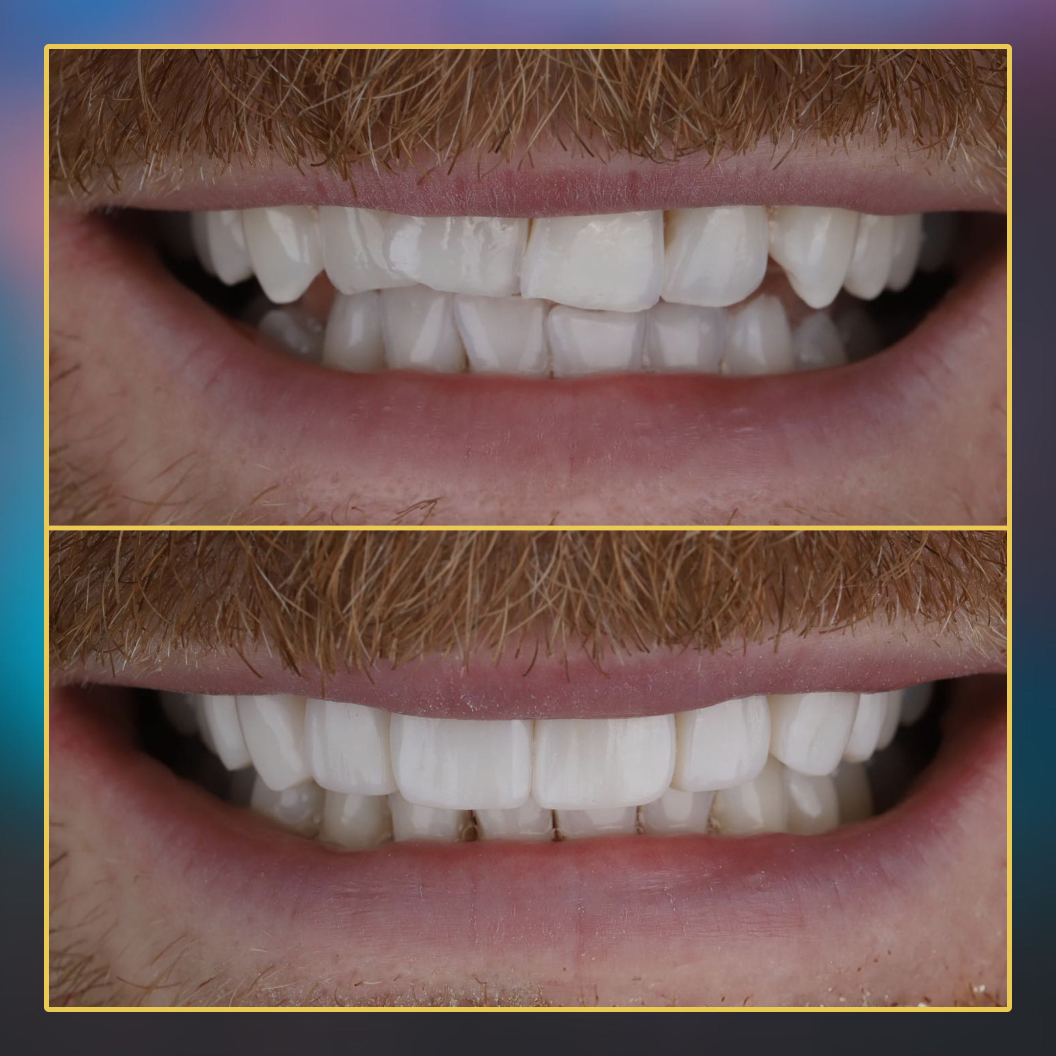 Single visit, freehand composite bonding By @drliamdiamond