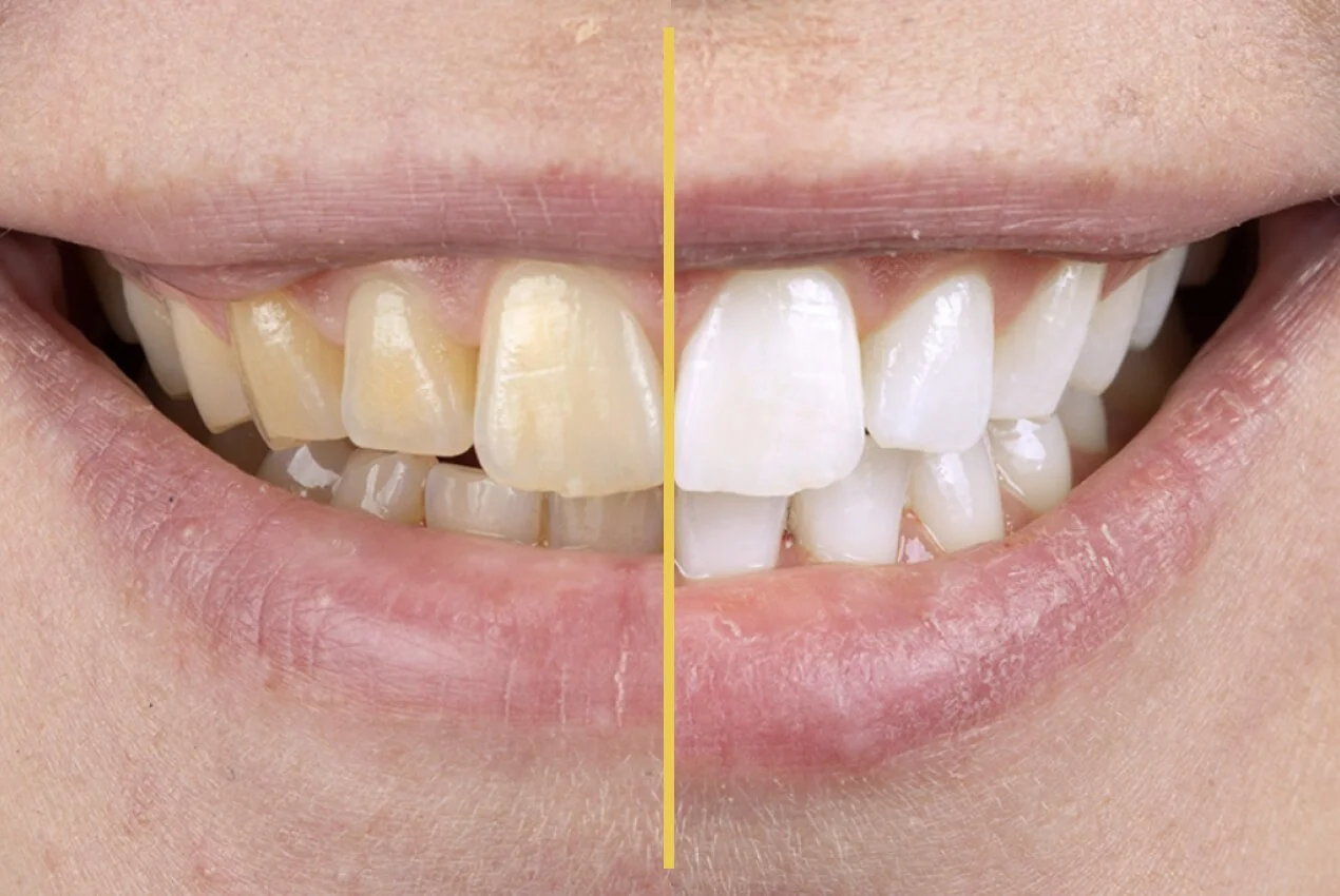 before-after-whitening@2x.jpg