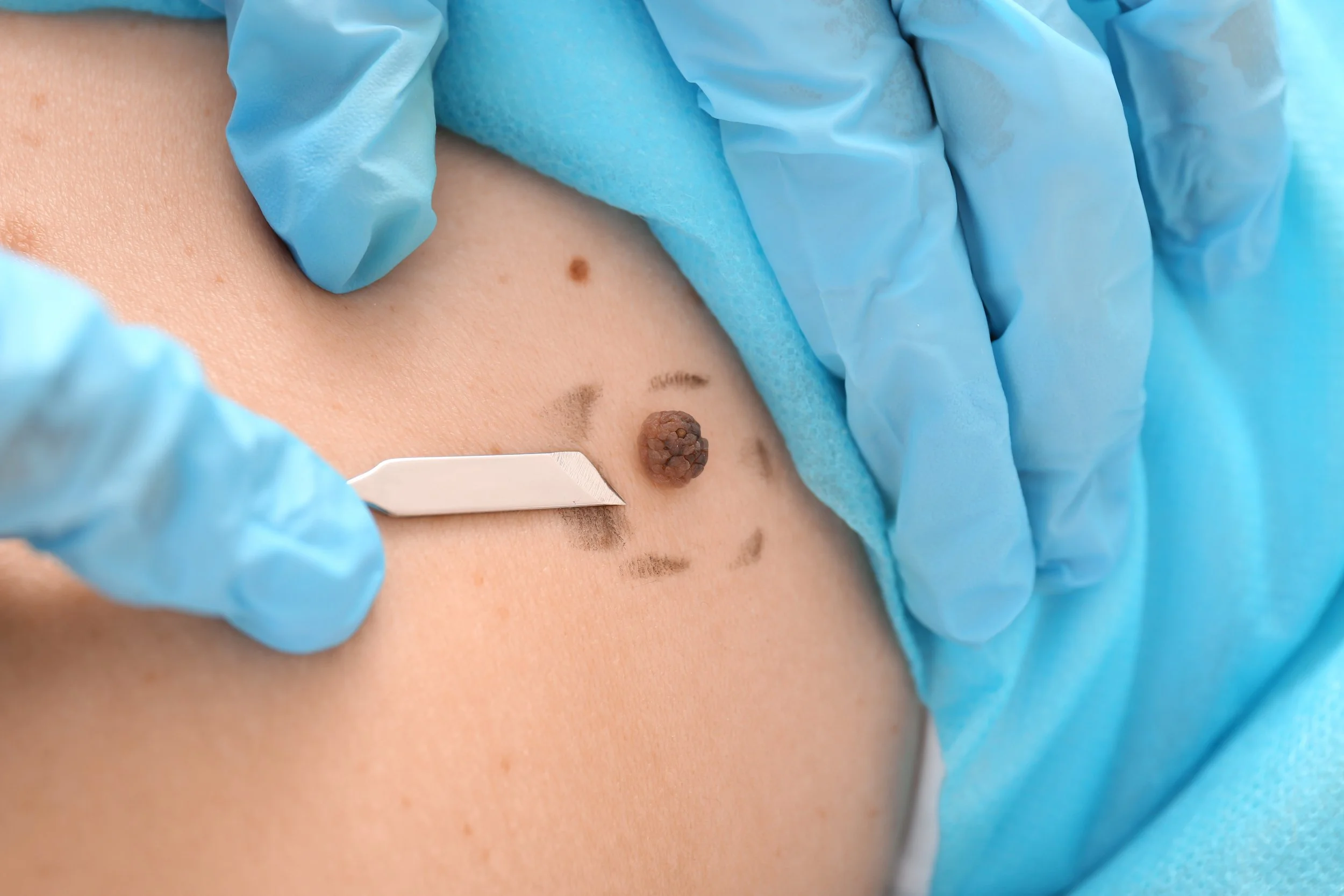 Surgical Dermatology — Dorado Dermatology