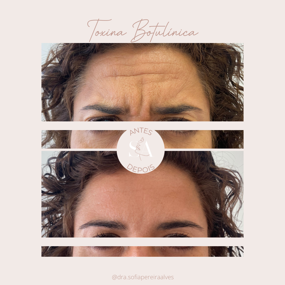 antes e depois tb _.PNG