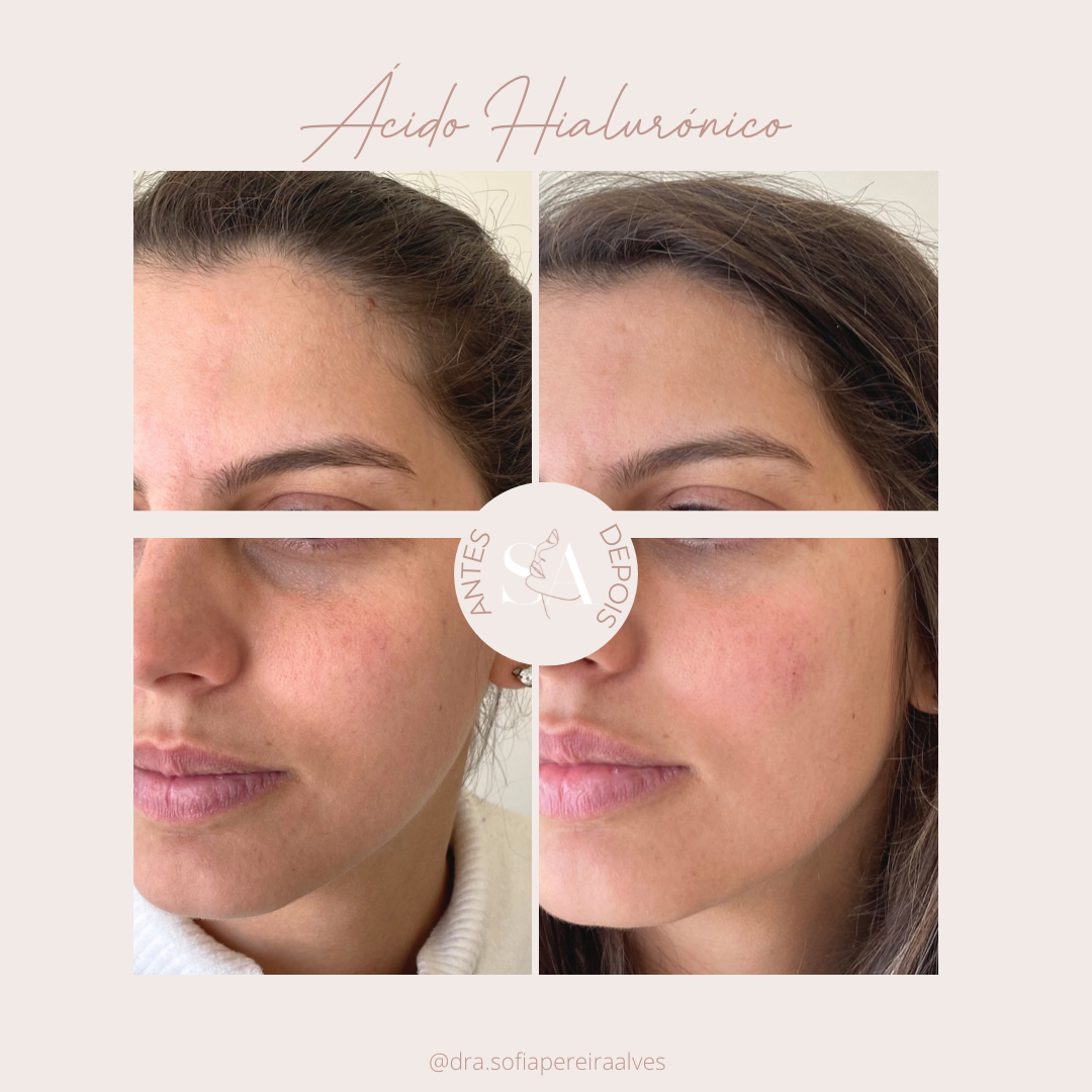 acido hialuronico__.PNG