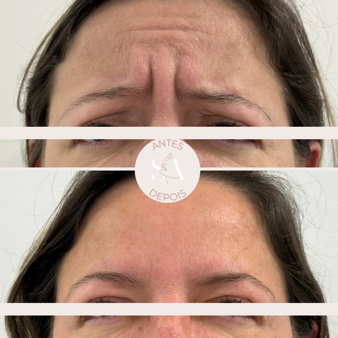Resultado de um tratamento com 𝘁𝗼𝘅𝗶𝗻𝗮 𝗯𝗼𝘁𝘂𝗹í𝗻𝗶𝗰𝗮 ✨
✔️Objetivo: reduzir as rugas de expressão da região da glabela (zona entre as sobrancelhas)
👀 Resultado: efeito a partir do 3°-5° dia, sendo máxim