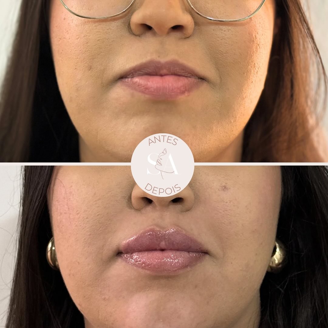 𝙇𝙄𝙋𝙎 👄
A medicina estética é uma prática que deve ser 𝘱𝘦𝘳𝘴𝘰𝘯𝘢𝘭𝘪𝘻𝘢𝘥𝘢!
É crucial alinhar as expectativas e desejos estéticos de cada paciente para obter resultados que reflitam a essência &u