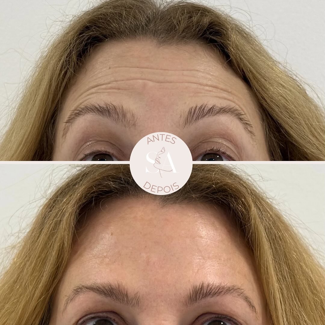Ainda existe muito preconceito associado à toxina botulínica, o famoso Botox®! 💉
Mas, com a técnica e quantidade correta, o resultado pode ser muito 𝗯𝗼𝗻𝗶𝘁𝗼 𝗲 𝗻𝗮𝘁𝘂𝗿𝗮𝗹 🤩
Neste caso, com uma aplicaç&atil