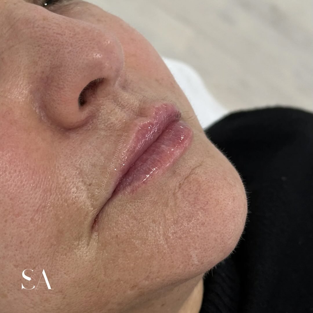 𝙇𝙄𝙋𝙎 👄
O tratamento dos lábios com ácido hialurónico nem sempre se baseia apenas em volumizar!
Este procedimento pode ser usado para 𝗿𝗲𝗷𝘂𝘃𝗲𝗻𝗲𝘀𝗰𝗶𝗺𝗲𝗻𝘁𝗼 𝗱𝗮 𝗿𝗲𝗴𝗶ã𝗼 𝗽𝗲𝗿𝗶𝗼𝗿𝗮𝗹:
✔️ Recuperar