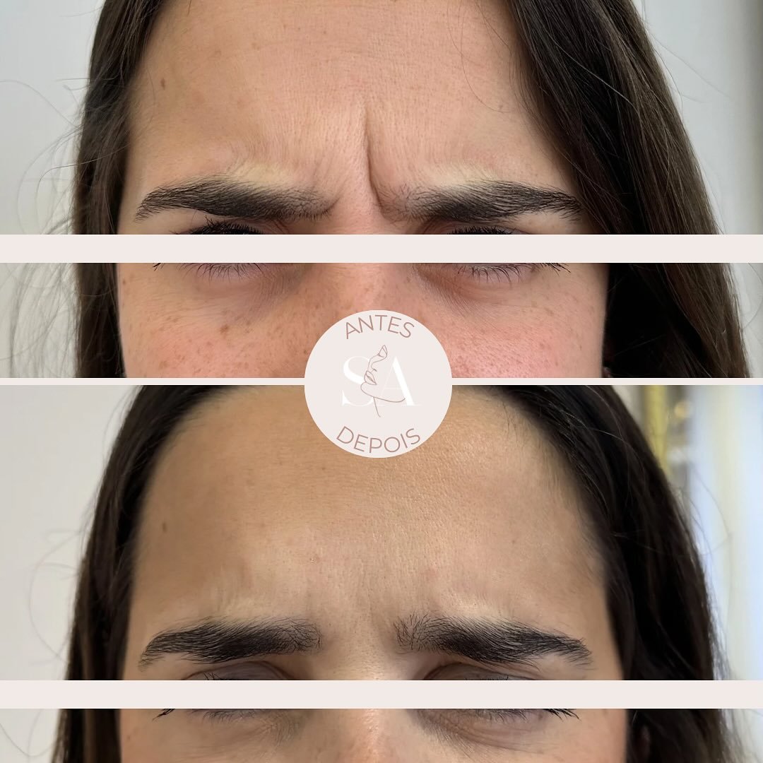𝙏𝙊𝙓𝙄𝙉𝘼 𝘽𝙊𝙏𝙐𝙇Í𝙉𝙄𝘾𝘼 ✨
✔️Objetivo: suavizar as rugas de expressão da região da glabela (zona entre as sobrancelhas)
👀 Resultados: efeito a partir do 3°-5° dia, sendo máximo ao fim de 15 dias
🗓 Dura&