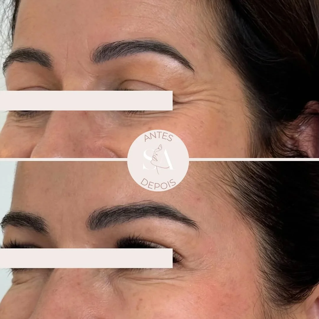 Sabia que para além de melhorar as rugas de expressão, a toxina botulínica também ajuda a 𝙚𝙡𝙚𝙫𝙖𝙧 𝙖 𝙘𝙖𝙪𝙙𝙖 e 𝙖𝙘𝙚𝙣𝙩𝙪𝙖𝙧 𝙤 𝙖𝙧𝙦𝙪𝙚𝙖𝙢𝙚𝙣𝙩𝙤 𝙙𝙖𝙨 𝙨𝙤𝙗𝙧𝙖𝙣𝙘𝙚𝙡𝙝𝙖𝙨❓
É verdade!! E
