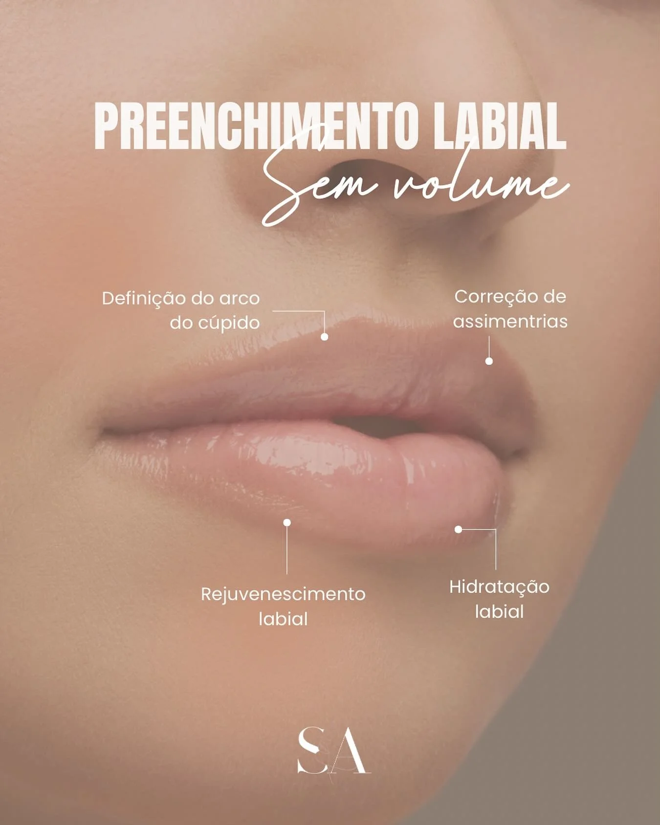 O tratamento dos lábios com ácido hialurónico 𝗻ã𝗼 𝘀𝗲 𝗯𝗮𝘀𝗲𝗶𝗮 𝗮𝗽𝗲𝗻𝗮𝘀 𝗲𝗺 𝘃𝗼𝗹𝘂𝗺𝗶𝘇𝗮𝗿 ‼️
Pode ser usado, por exemplo, para recuperar o contorno labial natural ou conseguir uma hidratação