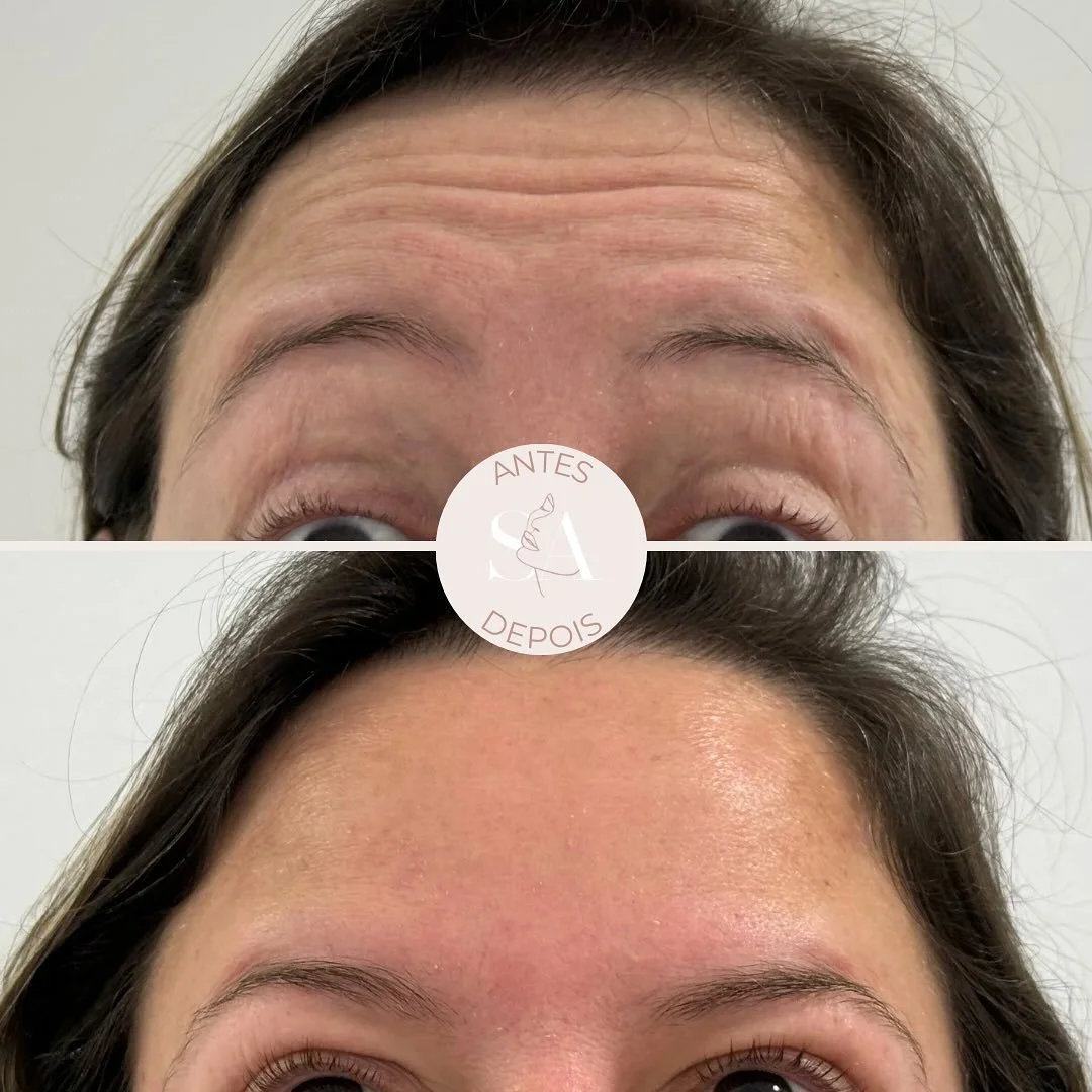 Ainda existe muito preconceito associado à toxina botulínica, o famoso Botox®! 💉
Mas a verdade é que, com a técnica e quantidade correta, o resultado pode ser muito 𝗯𝗼𝗻𝗶𝘁𝗼 𝗲 𝗻𝗮𝘁𝘂𝗿𝗮𝗹! 🤩
Conseguimos um