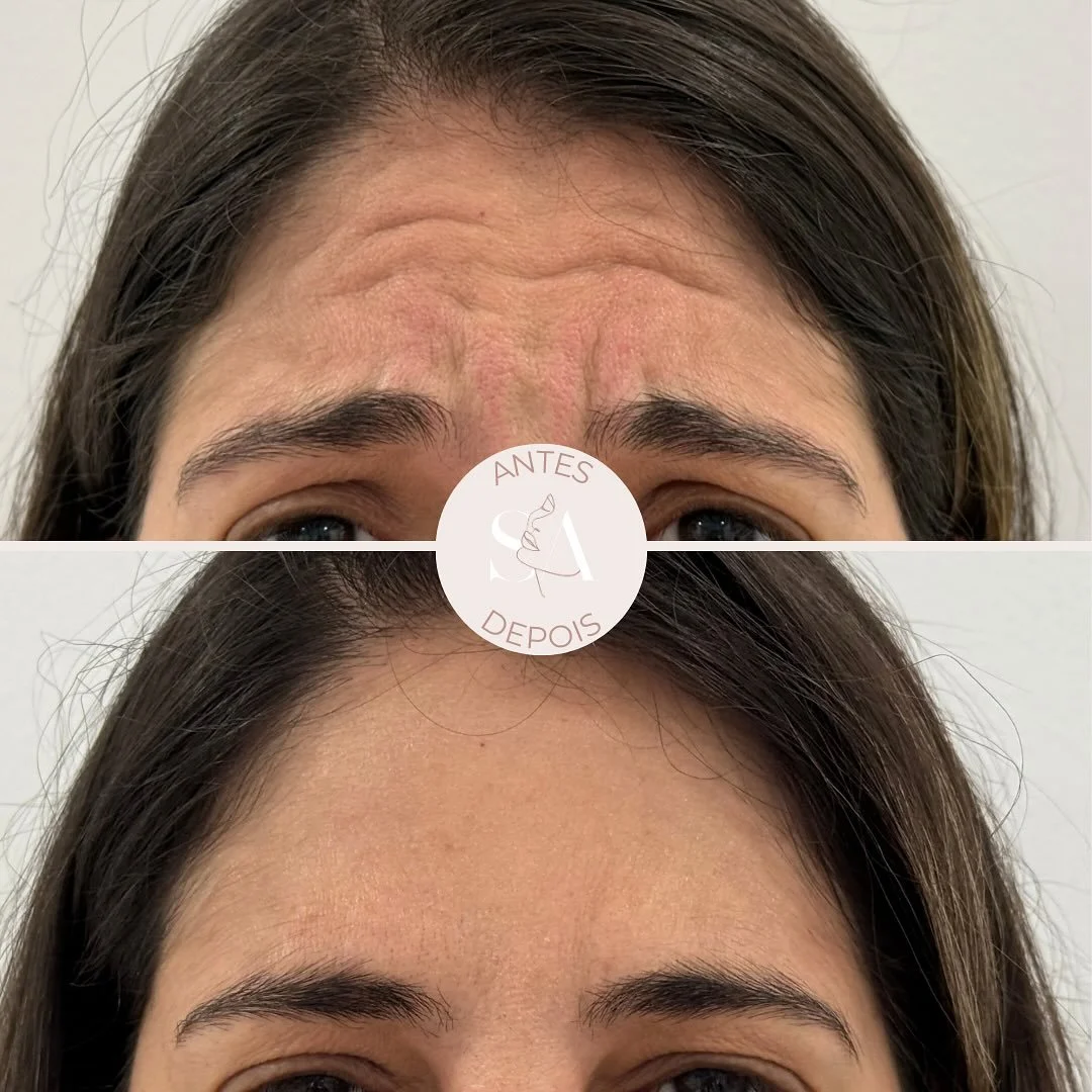 Mais um resultado de um tratamento com 𝙏𝙊𝙓𝙄𝙉𝘼 𝘽𝙊𝙏𝙐𝙇Í𝙉𝙄𝘾𝘼, o nosso tratamento estrela ✨
O que conseguimos obter:
✔️ Rugas de expressão suavizadas
✔️ Melhoria do arqueamento das sobrancelhas
✔️ Melhoria da qualidade da p