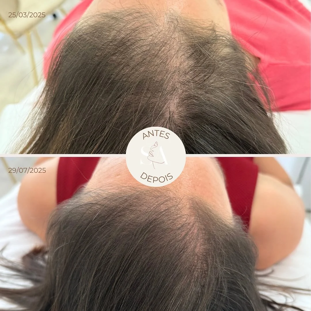 O poder do 𝗽𝗹𝗮𝘀𝗺𝗮 𝗿𝗶𝗰𝗼 𝗲𝗺 𝗽𝗹𝗮𝗾𝘂𝗲𝘁𝗮𝘀 (𝗣𝗥𝗣) no tratamento da alopécia ✨
✔️ Estimula o crescimento e fortalecimento do cabelo
✔️ Melhora o volume e densidade dos fios
✔️ Previne a perda folicular/queda de cabelo
📸 𝘌𝘴