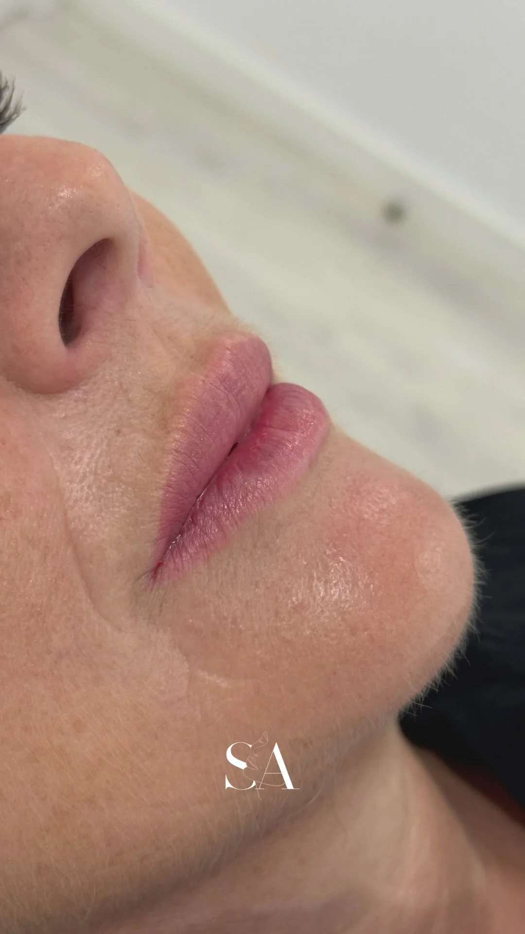 ᴘʀᴇᴇɴᴄʜɪᴍᴇɴᴛᴏ ʟᴀʙɪᴀʟ 👄
O objetivo deste procedimento é simples: realçar o lábio, 𝗦𝗘𝗠 𝗮𝗹𝘁𝗲𝗿𝗮𝗿 𝗲 𝗦𝗘𝗠 𝗲𝘅𝗮𝗴𝗲𝗿𝗮𝗿!
É a única forma de obtermos um resultado natural, que fique em perfeita harmonia