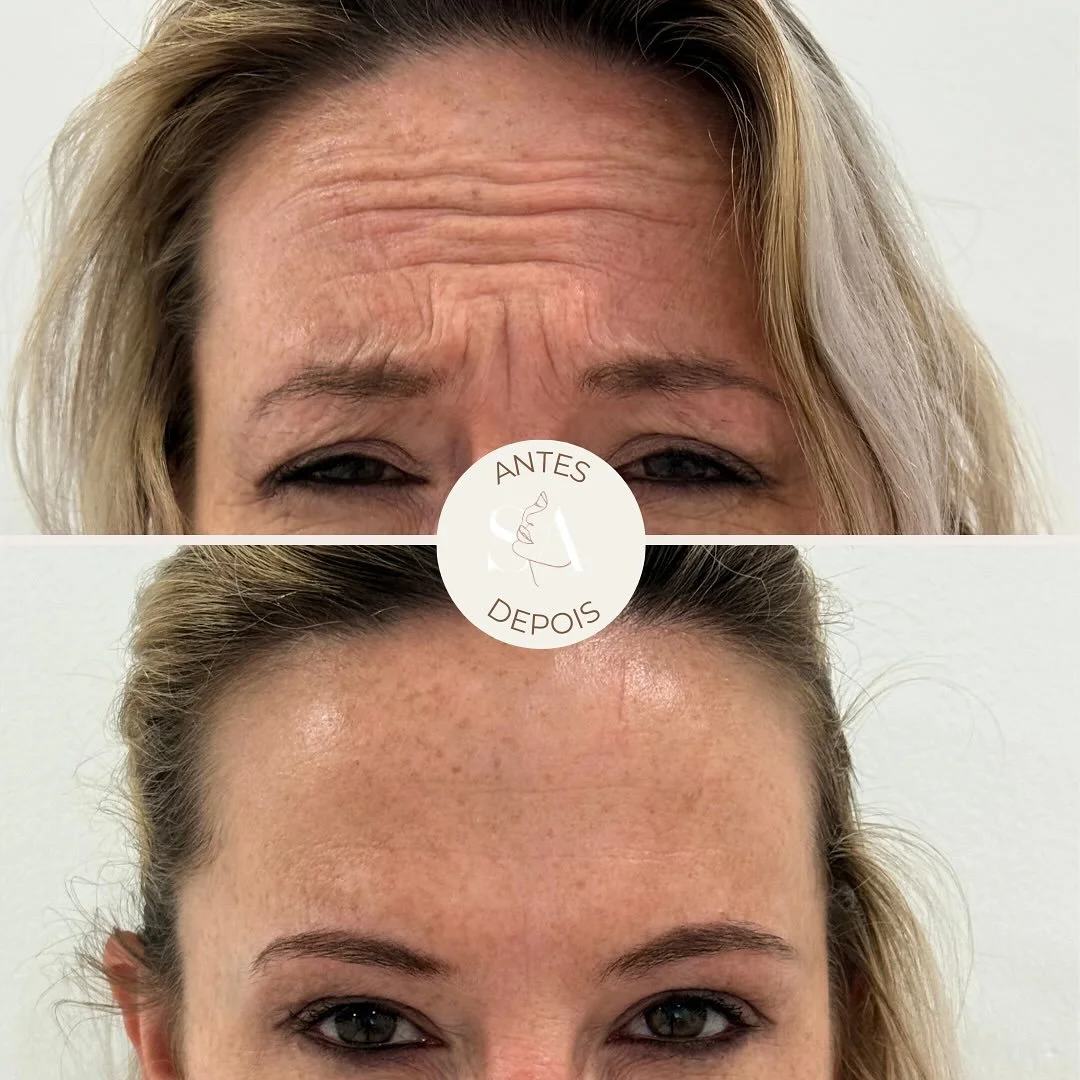 Tratamento com toxina botulínica = 𝗿𝗲𝗷𝘂𝘃𝗲𝗻𝗲𝘀𝗰𝗶𝗺𝗲𝗻𝘁𝗼 𝗱𝗼 𝗿𝗼𝘀𝘁𝗼 SEM comprometer a expressão facial genuína dos pacientes ✨
O que conseguimos obter com este procedimento:
✔️ Suavização das rugas