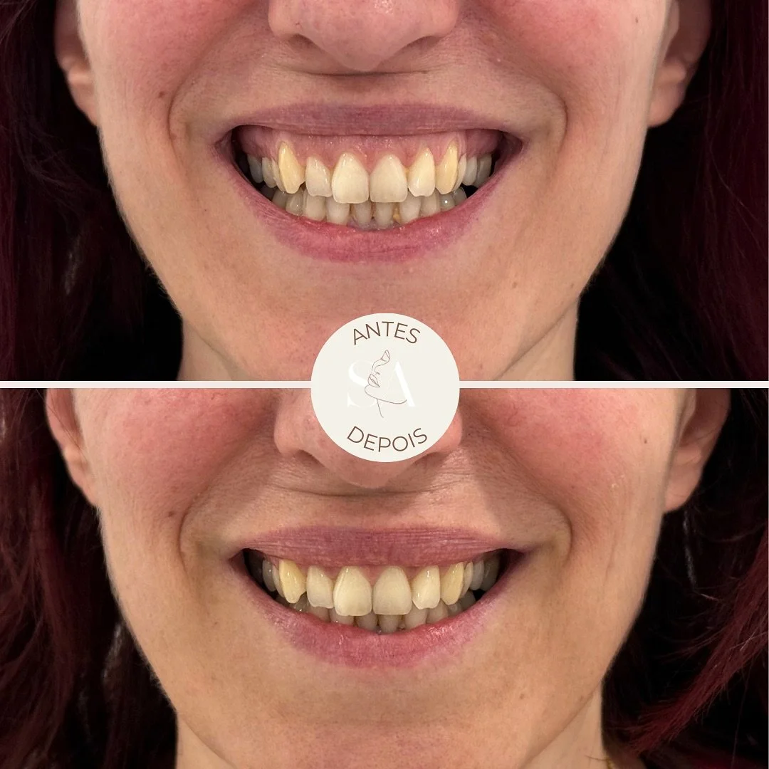 J&aacute; reparou que, ao sorrir, algumas pessoas mostram muito mais gengiva do que outras? 🤔

&Eacute; conhecido como 𝗦𝗢𝗥𝗥𝗜𝗦𝗢 𝗚𝗘𝗡𝗚𝗜𝗩𝗔𝗟! 

Ap&oacute;s avaliar em consulta, conseguimos identificar quais as causas da exposi&ccedil;&atil