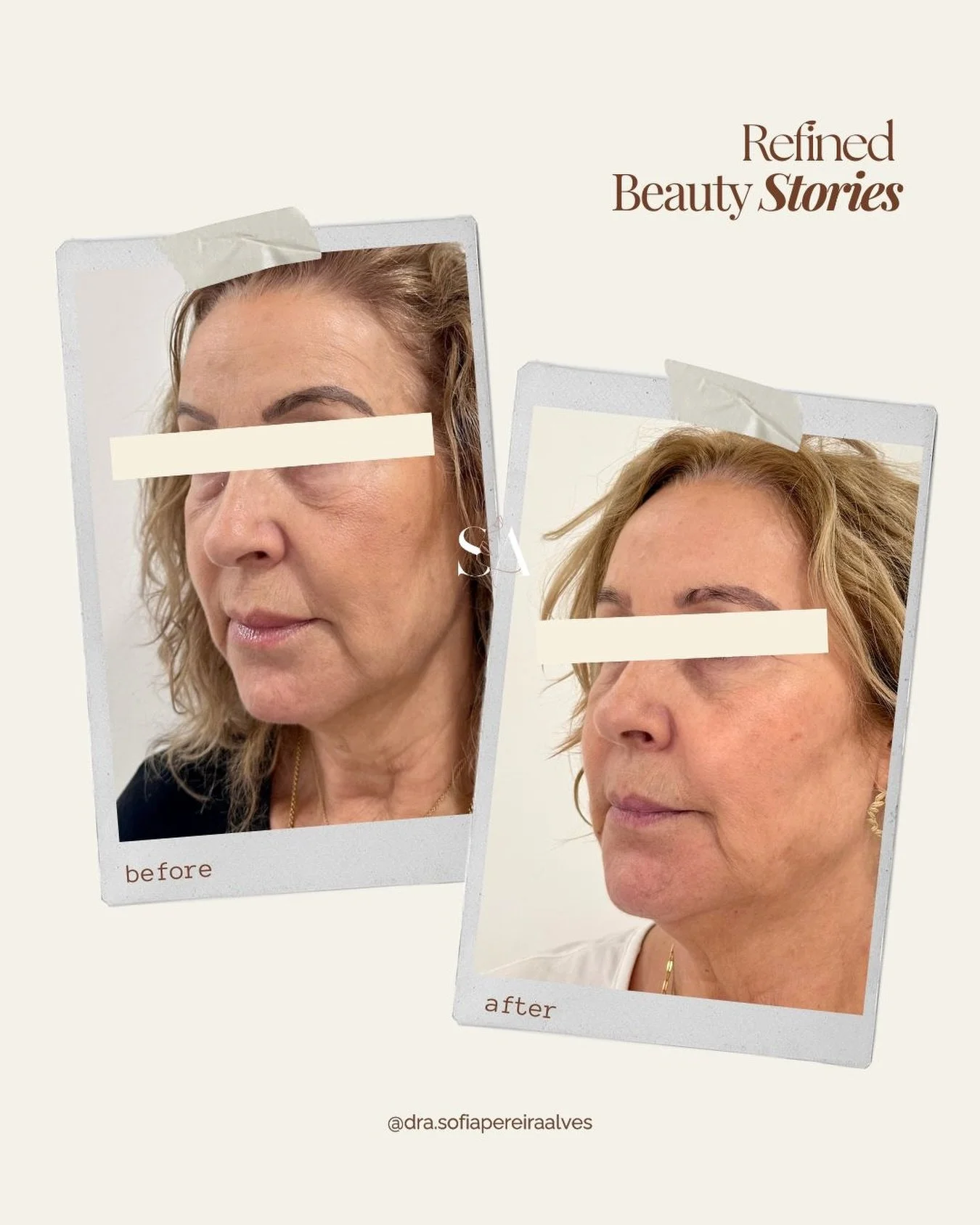 𝘙𝘦𝘧𝘪𝘯𝘦𝘥 𝘉𝘦𝘢𝘶𝘵𝘺 𝘚𝘵𝘰𝘳𝘪𝘦𝘴 🤍

Muito mais do que uma mudan&ccedil;a est&eacute;tica, este resultado reflete autocuidado, confian&ccedil;a e a decis&atilde;o de investir em si.

Atrav&eacute;s de uma 𝗮𝗯𝗼𝗿𝗱𝗮𝗴𝗲𝗺 𝗽𝗲𝗿𝘀𝗼𝗻𝗮𝗹