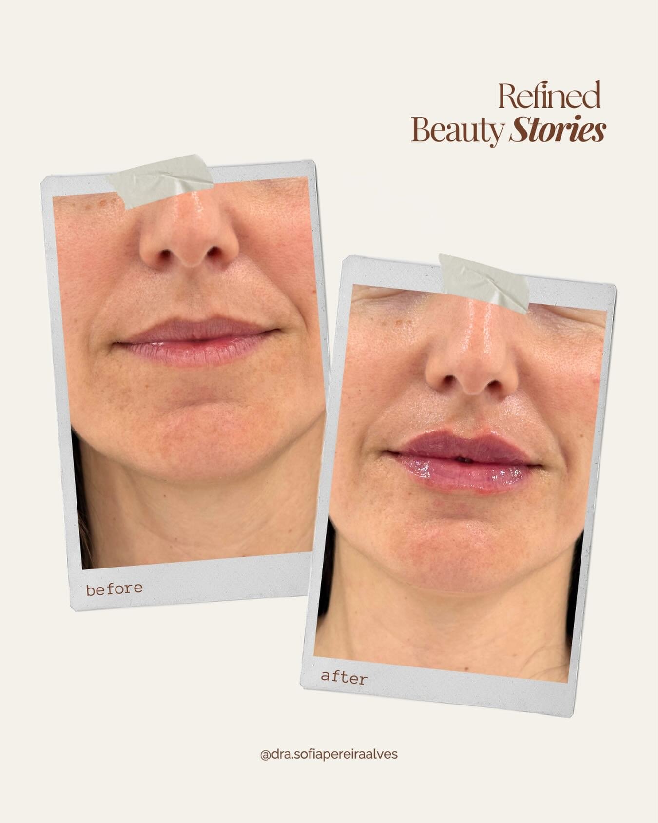 𝘙𝘦𝘧𝘪𝘯𝘦𝘥 𝘉𝘦𝘢𝘶𝘵𝘺 𝘚𝘵𝘰𝘳𝘪𝘦𝘴 🤍

Um resultado subtil, pensado para 𝗿𝗲𝗮𝗹&ccedil;𝗮𝗿 𝗮 𝗯𝗲𝗹𝗲𝘇𝗮 𝗻𝗮𝘁𝘂𝗿𝗮𝗹 𝗱𝗲 𝗳𝗼𝗿𝗺𝗮 𝗱𝗲𝗹𝗶𝗰𝗮𝗱𝗮 ✨  Neste preenchimento labial, procur&aacute;mos apenas aumentar a hidrata&ccedil;&a