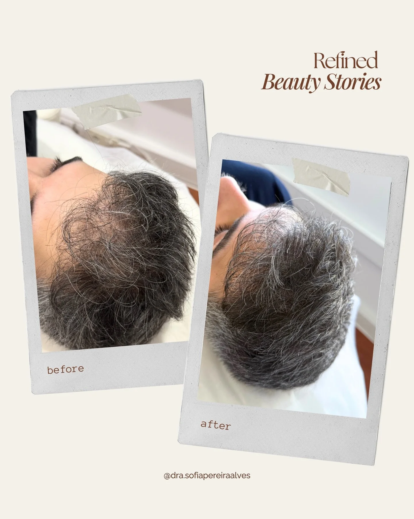 ✨ Antes &amp; Depois &ndash; Tratamento Capilar com PRP ✨

Este paciente procurava mais densidade, volume e fortalecimento do cabelo. Com apenas 4 sess&otilde;es de Plasma Rico em Plaquetas (PRP), estimul&aacute;mos a regenera&ccedil;&atilde;o dos fo