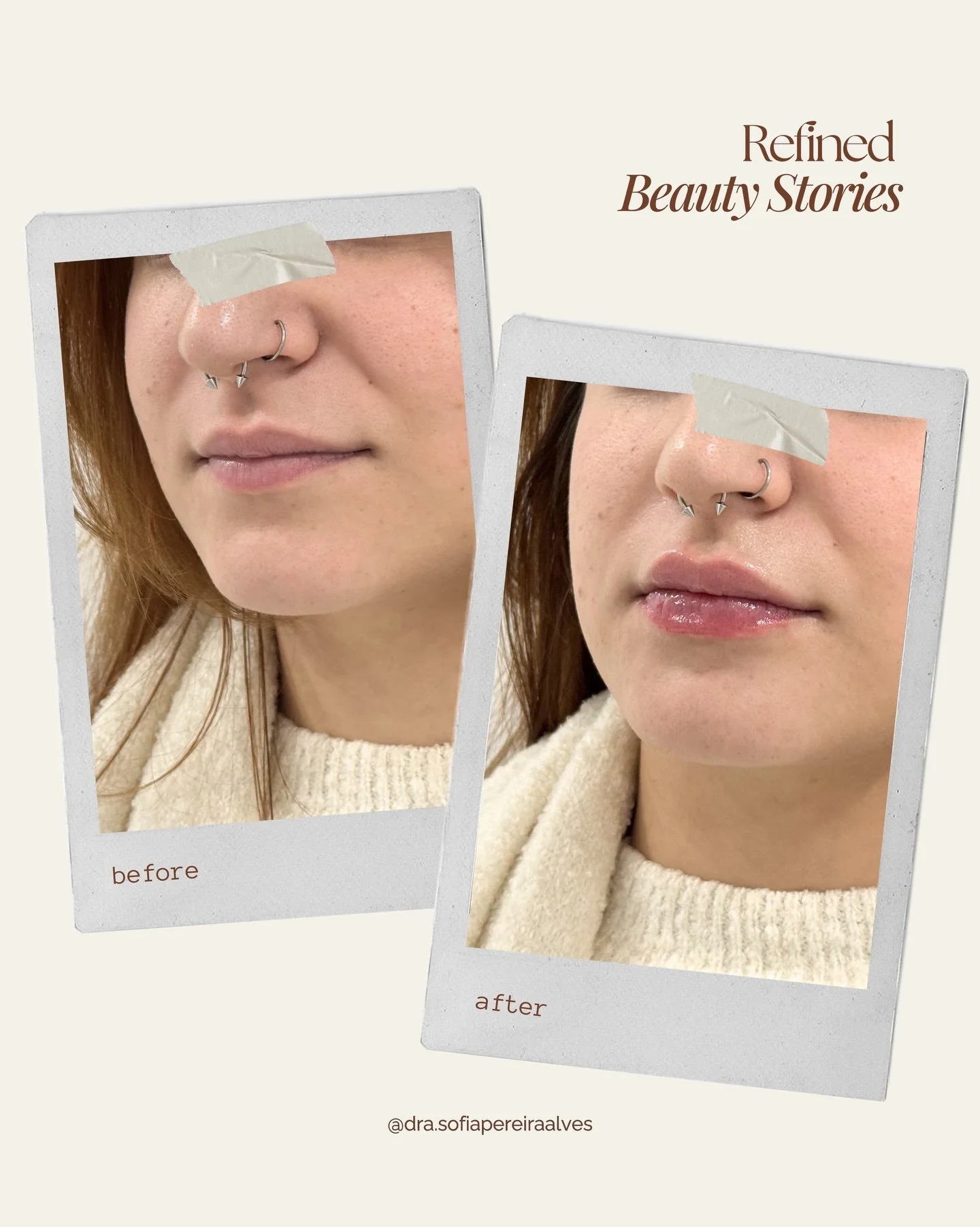 💫 𝑅𝑒𝑓𝑖𝑛𝑒𝑑 𝐵𝑒𝑎𝑢𝑡𝑦 𝑆𝑡𝑜𝑟𝑖𝑒𝑠: 𝑃𝑟𝑒𝑒𝑛𝑐ℎ𝑖𝑚𝑒𝑛𝑡𝑜 𝐿𝑎𝑏𝑖𝑎𝑙 💫

A nossa paciente queria melhorar a regi&atilde;o dos l&aacute;bios: mais volume e mais hidrata&ccedil;&atilde;o, mas mantendo a sua naturalidade. 

Com o uso de