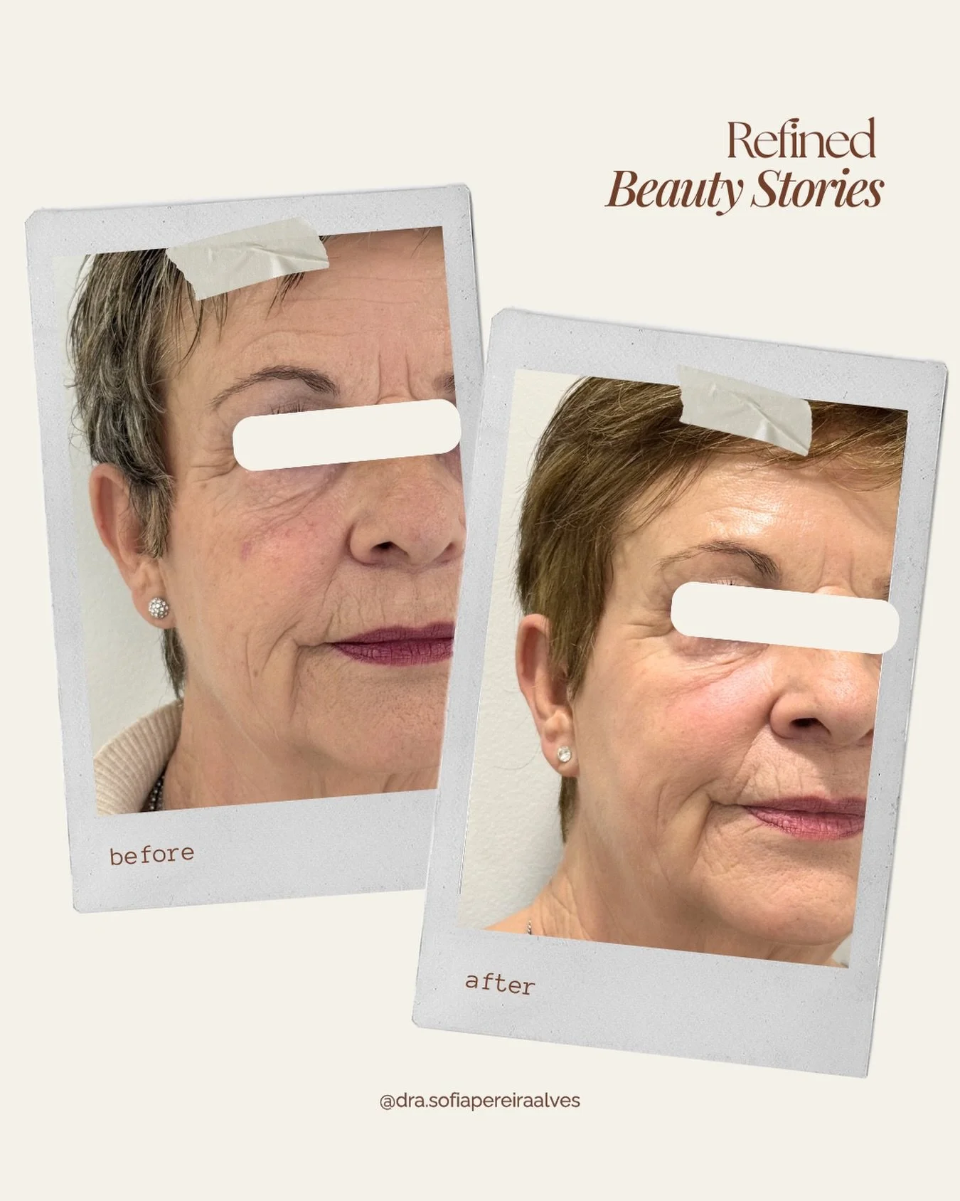 ✨ 𝑹𝒆𝒇𝒊𝒏𝒆𝒅 𝑩𝒆𝒂𝒖𝒕𝒚 𝑺𝒕𝒐𝒓𝒊𝒆𝒔 ✨

Rejuvenescer n&atilde;o &eacute; mudar.  &Eacute; devolver &agrave; pele a qualidade, a luz e a firmeza que o tempo vai levando.

Este resultado &eacute; fruto de um plano totalmente personalizado, onde