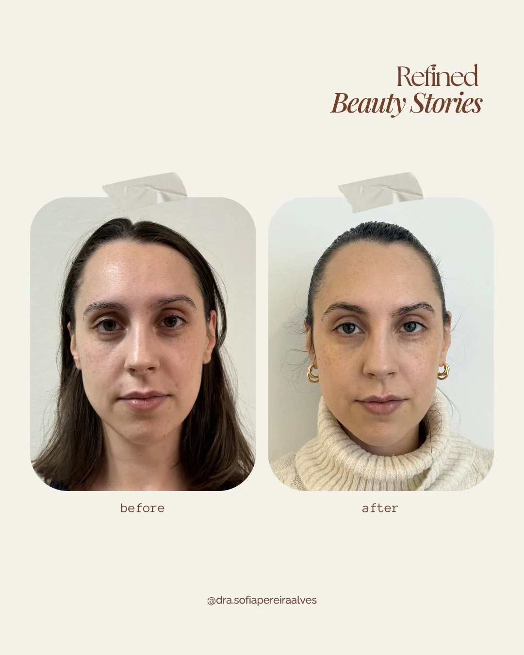 Este &eacute; o resultado do Protocolo Periocular: a sinergia perfeita entre o Liftera e a Toxina Botul&iacute;nica para corrigir a assimetria das sobrancelhas.

O resultado &eacute; uma sobrancelha mais arqueada e uma express&atilde;o leve e descans