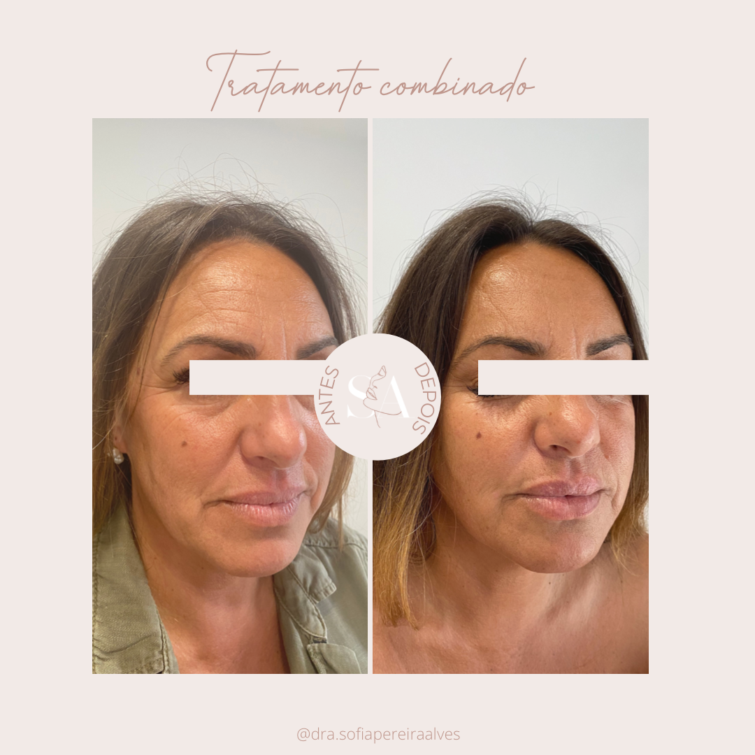 tratamento combinado___.PNG