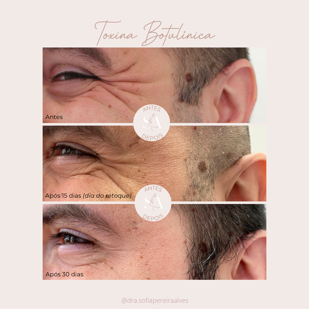 antes e depois tb.PNG