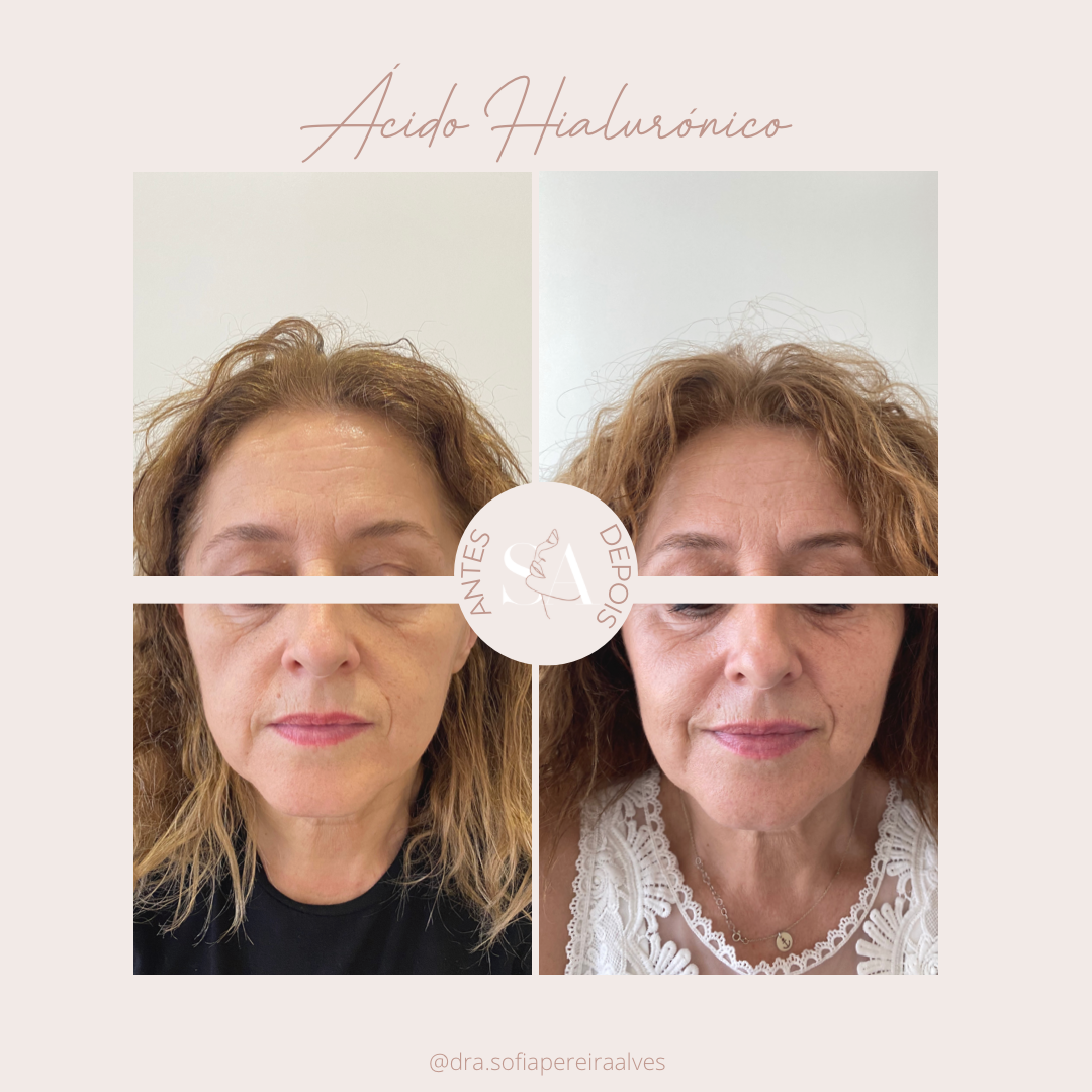 antes e depois acido hialurónico.PNG