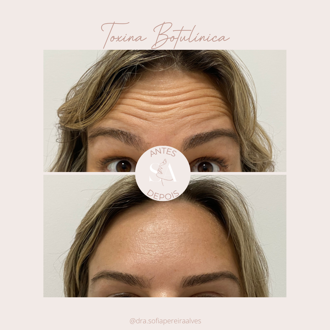 toxina botulinicaa.PNG