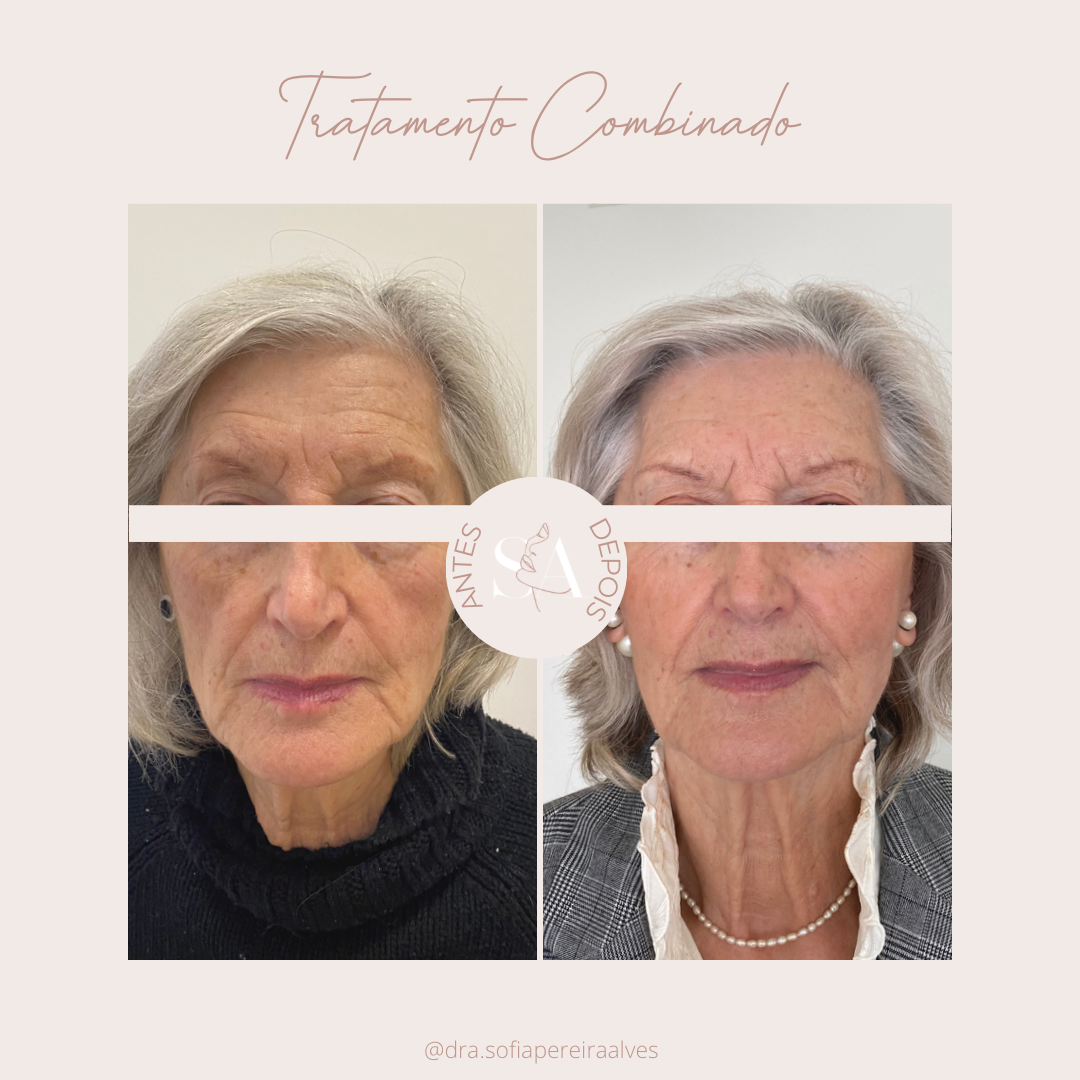 antes e depois tratamento combinado_.PNG