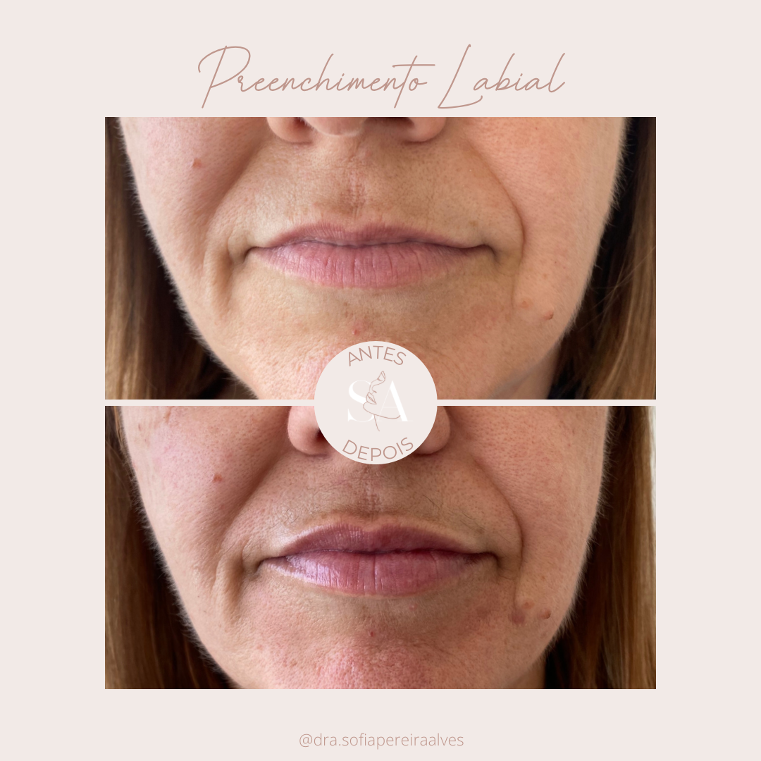 preenchimento labiaal.PNG