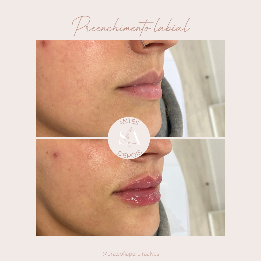 antes e depois preenchimento labial__.PNG