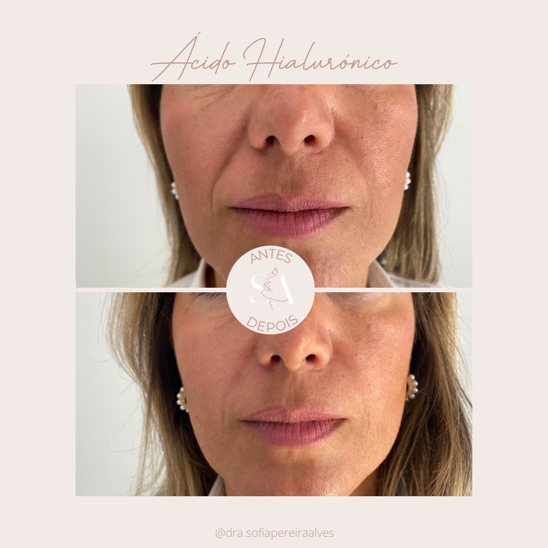 acido hialuronico____.PNG