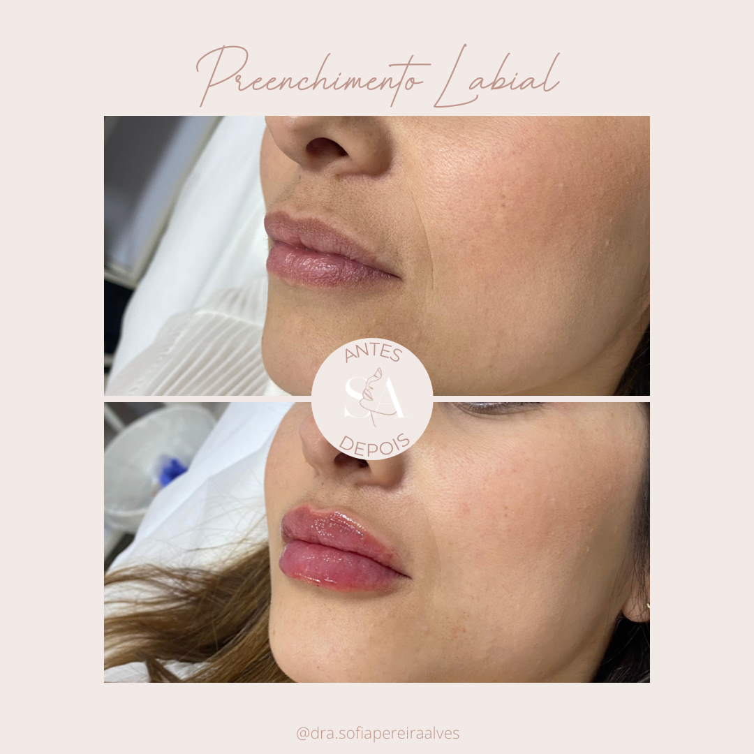 antes e depois preenchimento labial _.PNG