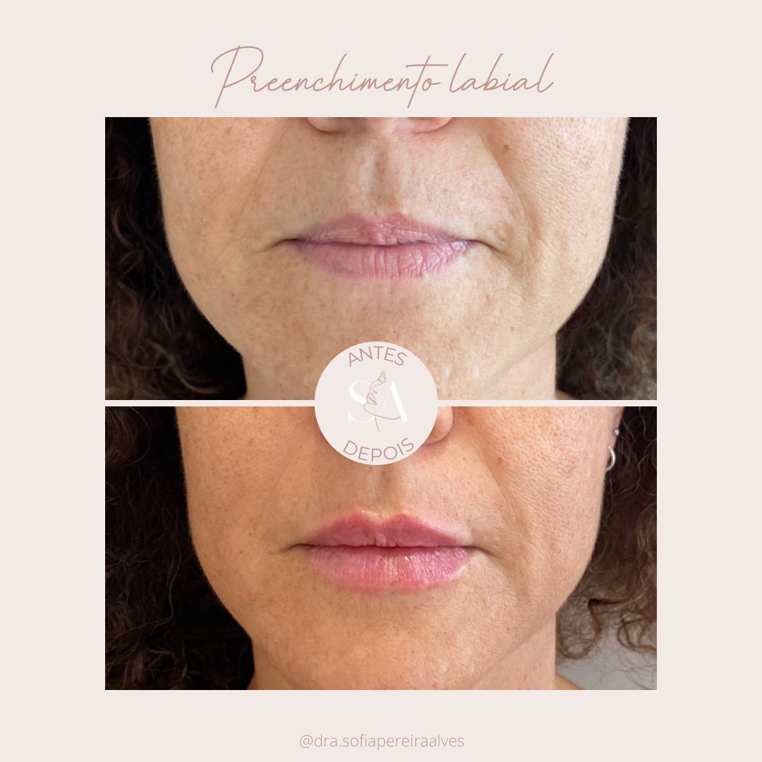antes e depois preenchimento labial___.PNG