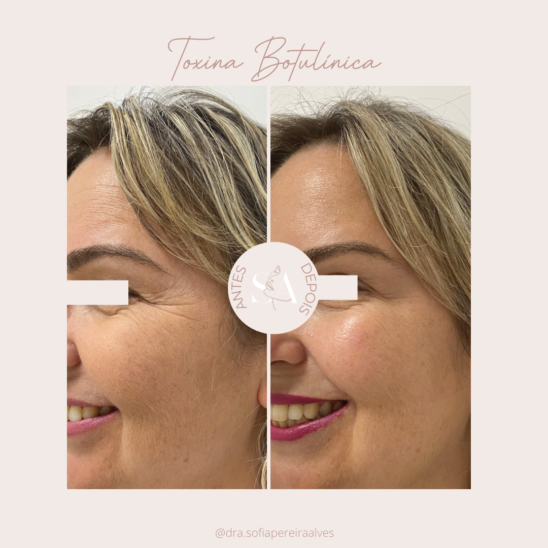 Antes e depois TB_.PNG