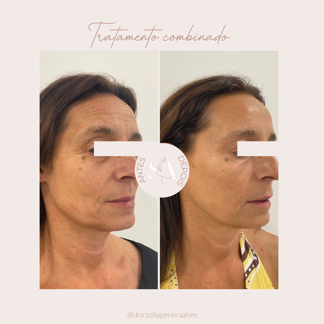 Antes e depois tratamento combinado.PNG