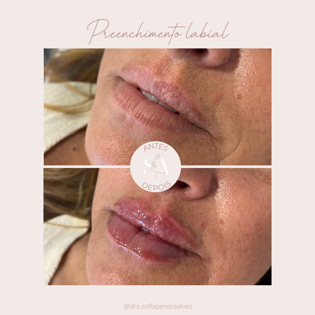 preenchimento_labial_.PNG