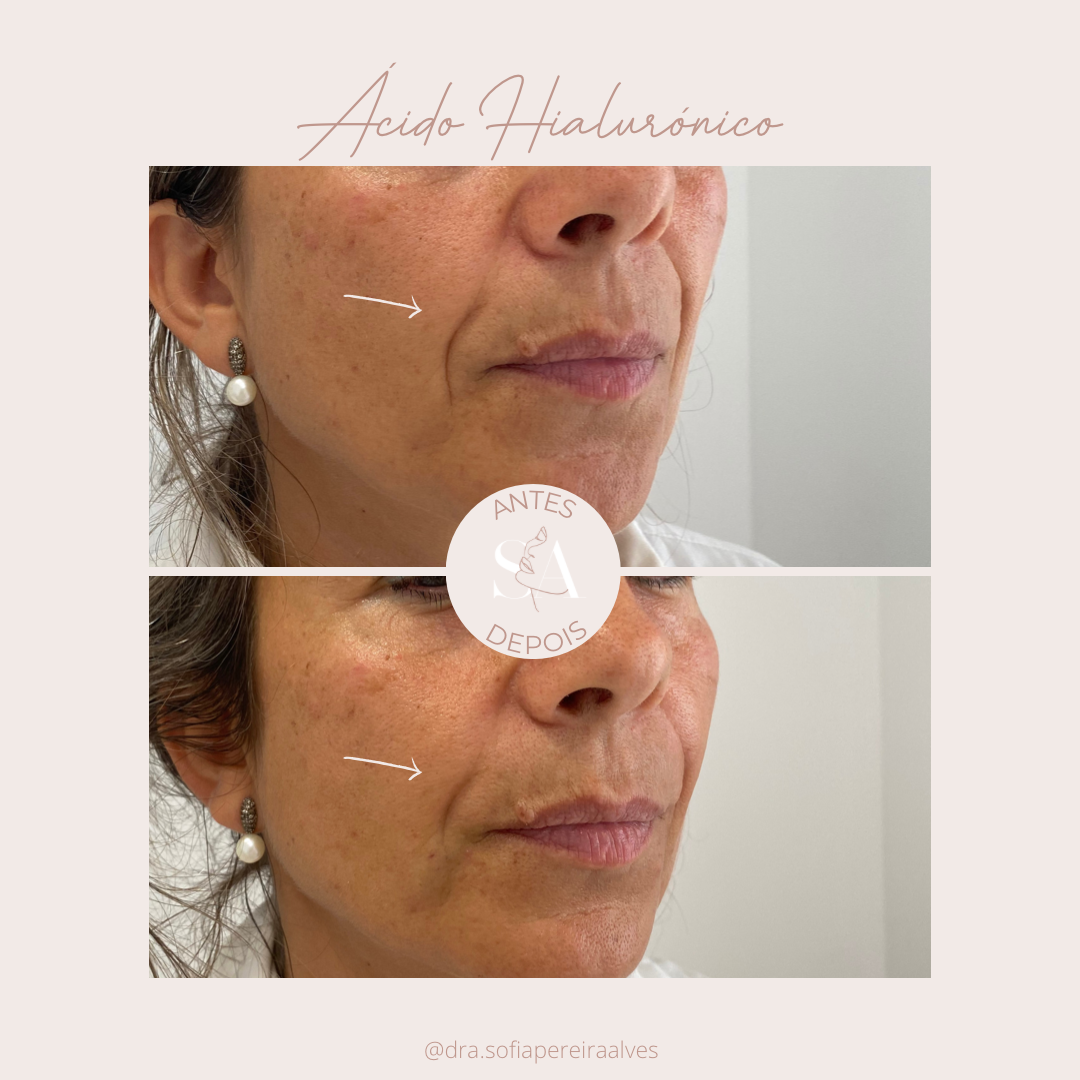 antes e depois AH.PNG