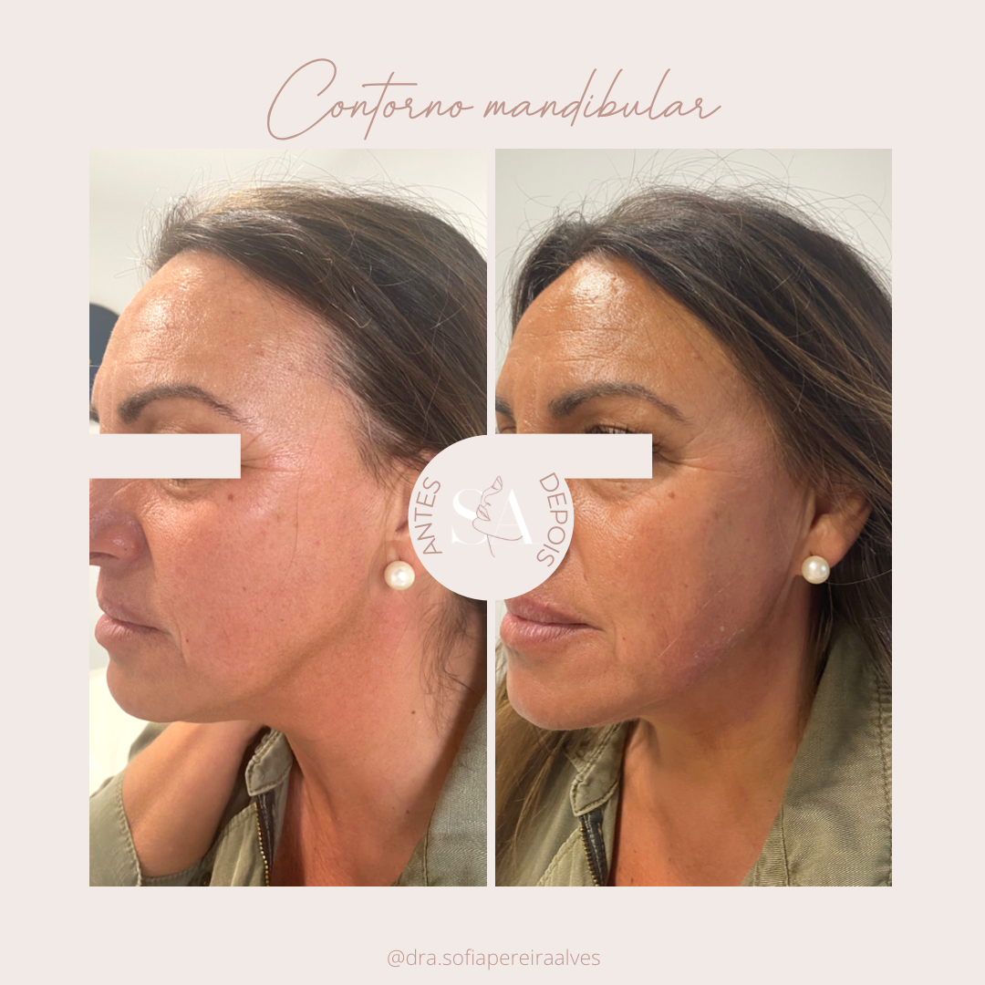 contorno mandibular.PNG