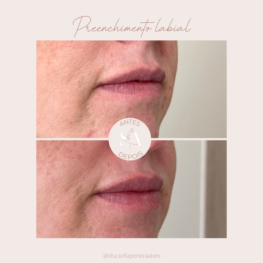 Antes e depois preenchimento labial.PNG